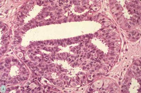 La Vigilancia es la Mejor Opción en Mujeres con Atipia Epitelial Plana