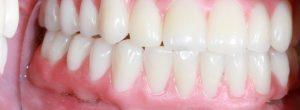Reemplazo permanente del diente para personas que no tienen dientes: implantes dentales versus dentaduras