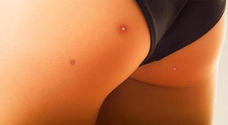 Acné en el trasero 10-datos-curiossos-sobre-los-traseros-que-no-sabias