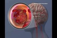 Cambio de Paradigma en la Terapia del Accidente Cerebrovascular