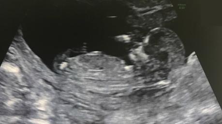 Algo late en mi Ecografia 12 semanas