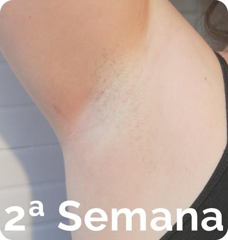 Philips lumea opinión antes después