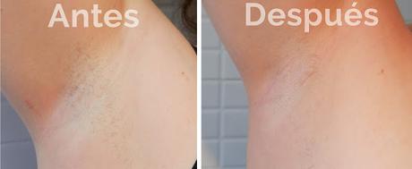 Antes Despues Philips Lumea