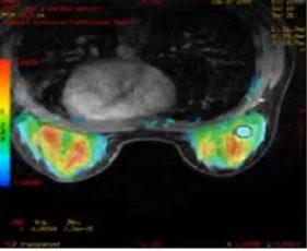 Difusión en resonancia magnética de mama