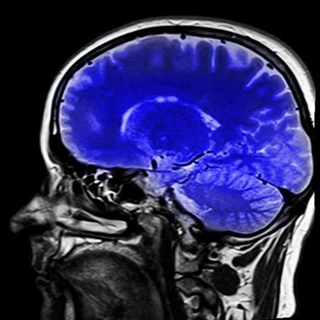 Adultos VIH positivo tratados muestran reducción de volumen cerebral