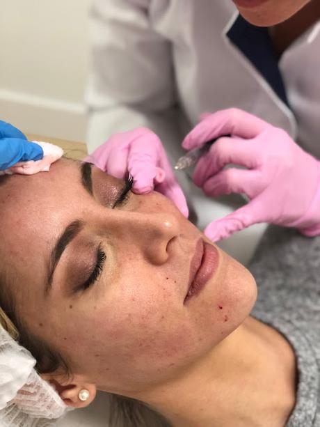 Fitness And Chicness-Tratamiento Acido Hialuronico Dra Ana Maldonado-4