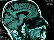 La esquizofrenia afecta a las redes de comunicación del cerebro