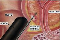 El Uso del Indice de Salud de la Próstata evita Biopsias innecesarias