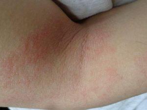 Dermatitis atopica en bebes eczema