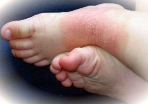 Dermatitis atopica en bebes dermatitis-atópica-pies-bebe