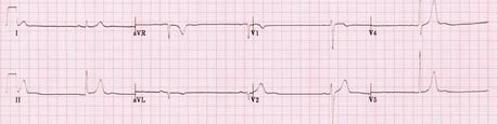 Electrocardiograma para detectar bradicardia sinusal