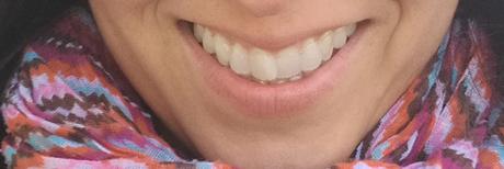 Me pongo aparato en los dientes de Invisaling