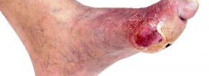 Úlceras del pie diabético explicadas