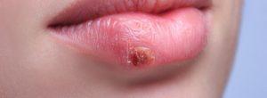 ¿Qué es lo que realmente necesita saber sobre el herpes labial?