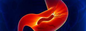 Vértigo / mareos después de comer H. Pylori infección del estómago