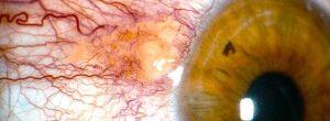 Suplementos naturales para la salud ocular: ¿funcionan? Pinguécula