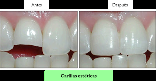 blanqueamiento dental, carillas estéticas, carillas de porcelana, sonrisa perfecta, snowdent, clínica dental, 