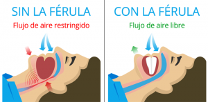 El Ronquido y su relación con la apnea del sueno ferula para ronquido y apnea dentista en madrid