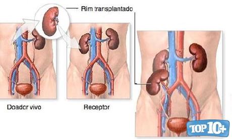Trasplante de riñón-entre-cirujias-mas-caras-del-mundo