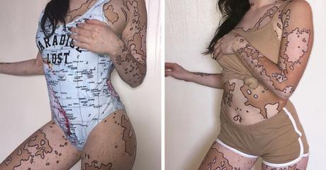 Después de ser Diagnosticada con Vitiligo, esta muchacha ahora adulta da vuelta a su cuerpo con un arte asombroso. Después de ser Diagnosticada con Vitiligo, esta muchacha ahora adulta da vuelta a su cuerpo con un arte asombroso.