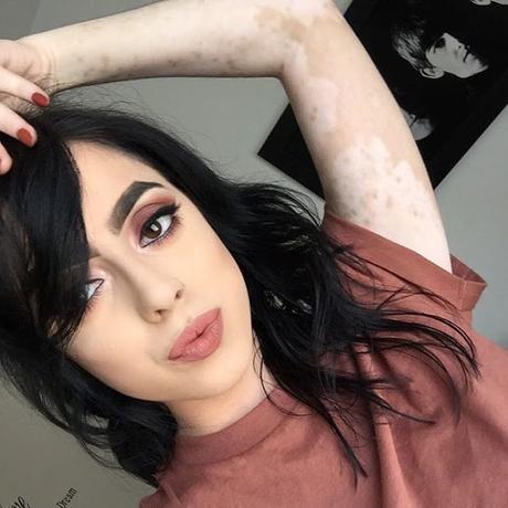 Después de ser Diagnosticada con Vitiligo, esta muchacha ahora adulta da vuelta a su cuerpo con un arte asombroso.