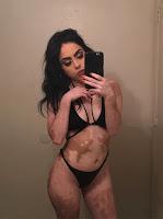 Después de ser Diagnosticada con Vitiligo, esta muchacha ahora adulta da vuelta a su cuerpo con un arte asombroso.