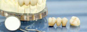 Puentes dentales, coronas e implantes: ¿reemplazo permanente de dientes en fumadores?