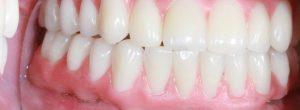 Reemplazo permanente del diente en pacientes con enfermedad de las encías ¿Qué tipo de dentista consultar para el reemplazo permanente del diente?