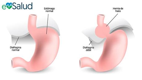 Hernia de hiato Hernia hiatal