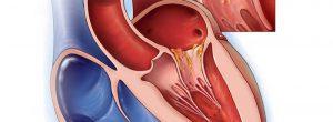 El sexo aumenta el riesgo de tener un ataque al corazón Endocarditis Infecciosa: tratamiento para las enfermedades del corazón