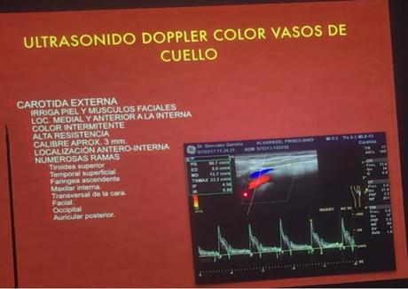 Características del ultrasonido Doppler de la arteria Carótida externa