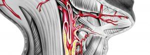 Enfermedad de la arteria carótida: síntomas y tratamientos de la estenosis