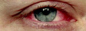 Enrojecimiento alrededor de los ojos puede tener muchas causas