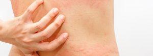 Urticaria: ¿por qué aparecen las colmenas?