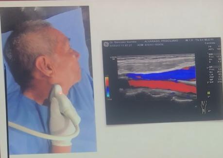 Doppler de vasos del cuello tercera parte