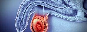 ¿Los adolescentes contraen cáncer? Cáncer testicular y otras condiciones testiculares