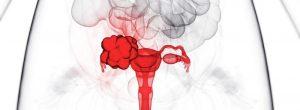 Edad y cáncer de ovario