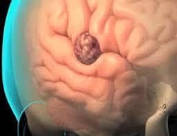 El simbolismo onírico al soñar con tumores.