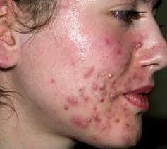 Como Eliminar El Acne Rapidamente En Casa