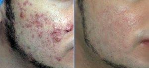 Como Quitar El Acne En Hombres