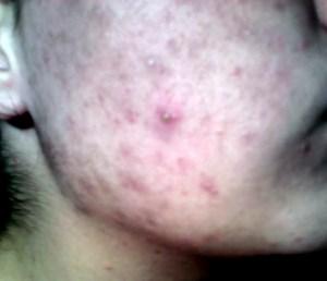 Como Quitar El Acne Dela Cara Rapidamente