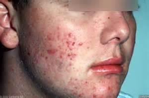 Como Eliminar El Acne Dela Cara Rapidamente