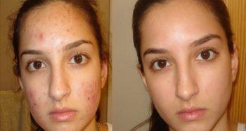 Como Eliminar El Acne Del Rostro Rapido