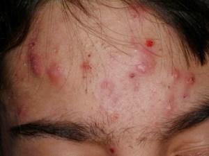 Como Eliminar El Acne Quistico Rapidamente Como Eliminar El Acne Quistico Rapidamente