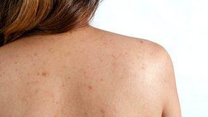 Como Eliminar El Acne Dela Espalda Rapidamente