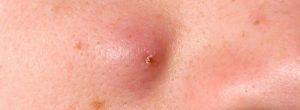 Inflamación mayor de la espinilla: ¿Por qué se infecta el acné?
