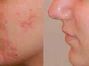 Como Combatir Acne Forma Natural