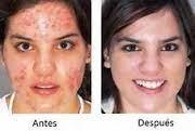Como Sacar El Acne Dela Cara Para Siempre