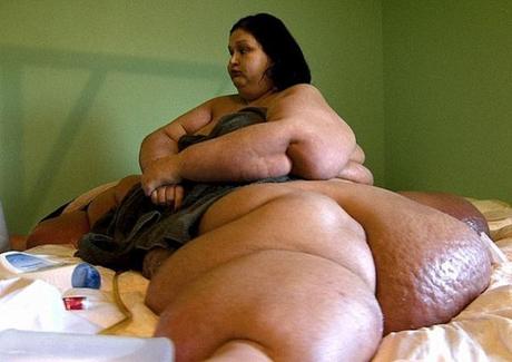Fotos de obesidad mórbida y casos célebres de superobesos