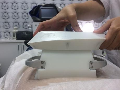 Criolipolisis o cómo reducir la grasa con frío Criolipolisis o cómo reducir la grasa con frío